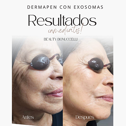 Dermapen_con_exisomas_29 12 2025