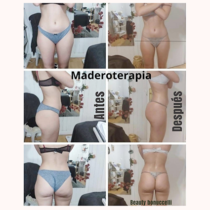 maderoterapia29 12 2025